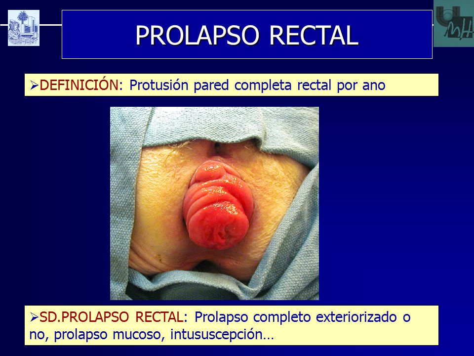 Sin prolapso cirugia tratamiento rectal